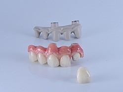 Peek/Np/Ti Implant Bridge Plus Crowns