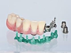 Acrylic Implant Bar Cr/Co Cast