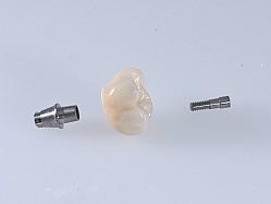 E-Max Implant Crown